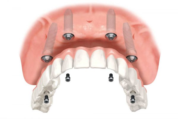 Illustration of a full arch implant being secured to jawbone